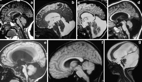enlarged cisterna magna in adults.